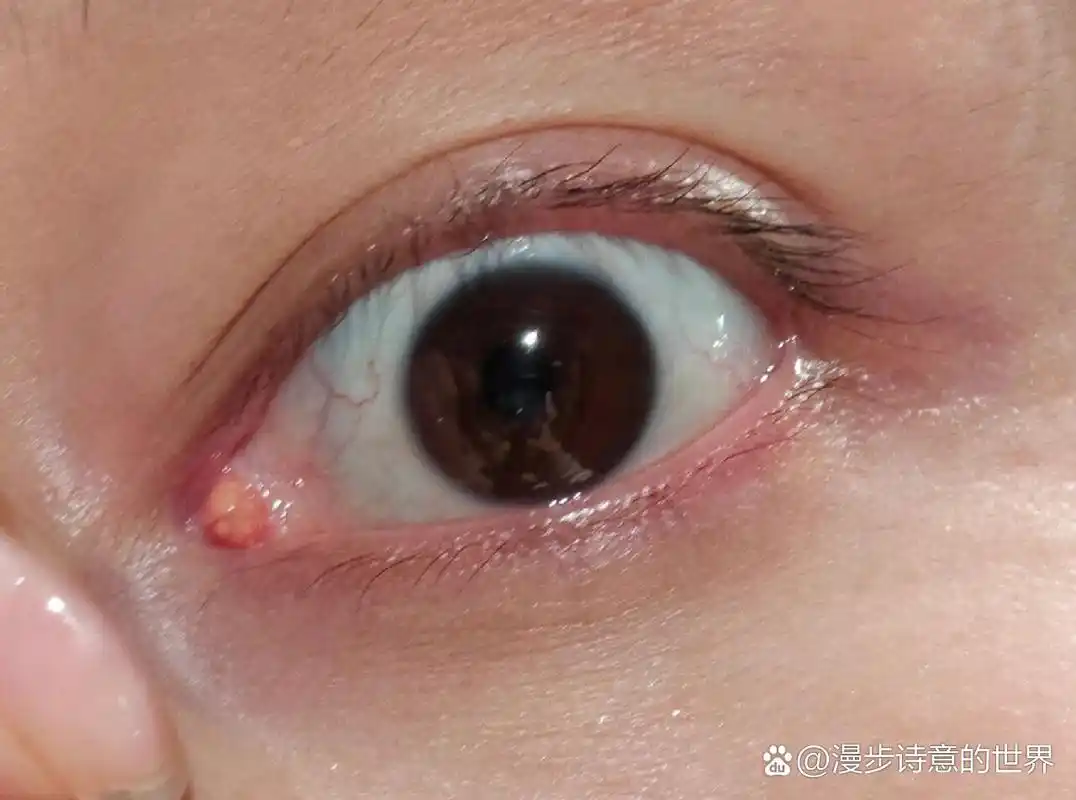 泪阜肿大 泪阜囊肿   大概2015年或者2016年,内眼角长了一颗肉疙瘩