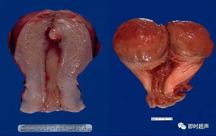 粘膜下肌瘤|浆膜下肌瘤|子宫肌瘤|宫颈肌瘤|-健康界