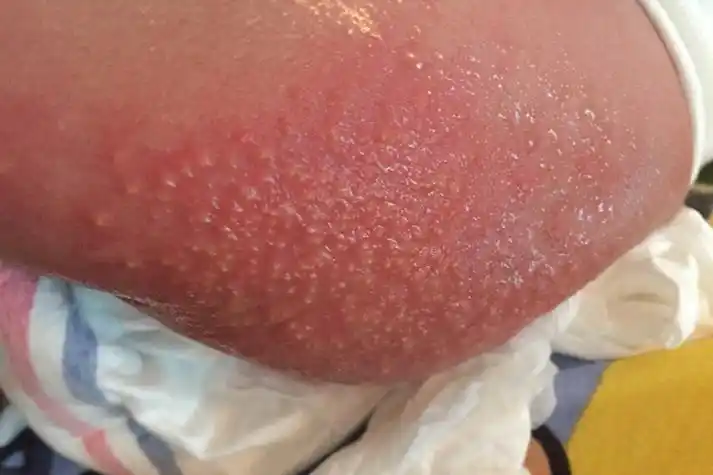 五个月婴儿起疹子图片_有来医生