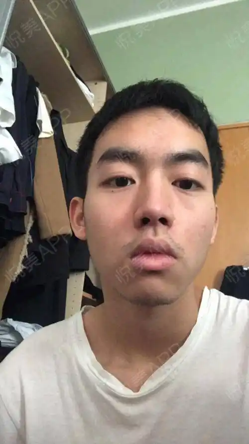 鼻基底术后239天_鼻型矫正术后239天_鼻综合术后239天_鼻小柱延长术后