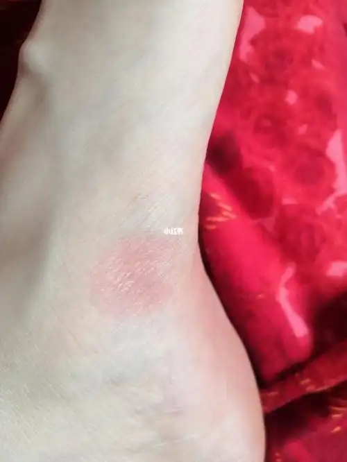 每年天热脚底就长红肿块