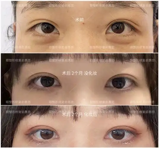双眼皮修复内眼角修复开案例术后2个月