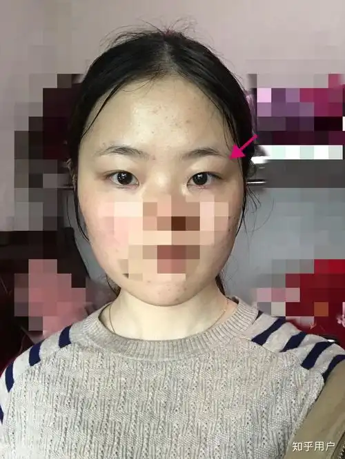 眼睛一高一低.向一边侧着睡,眼睛会变高还是变低? - 知乎