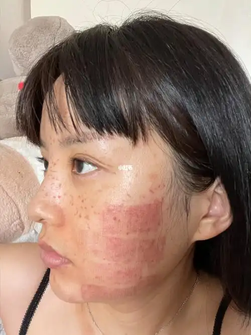 影响和风险激光祛斑抗黑技术的效果非常显着,一般在治疗后1-2周内