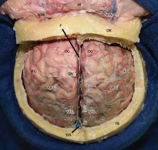 缩写:dv =引流静脉; f =大脑镰; fb =额骨; ifg =额下回; mfg =额中回