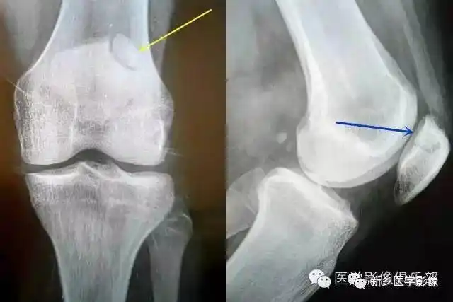 连接处可见一低密度弧状偷明线,宽窄均匀,边缘硬化轴位显示髌骨分左右
