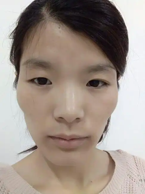觉得自己的脸型不好看,颧骨那块好高,呜呜呜😭 22岁的时候矫正牙齿