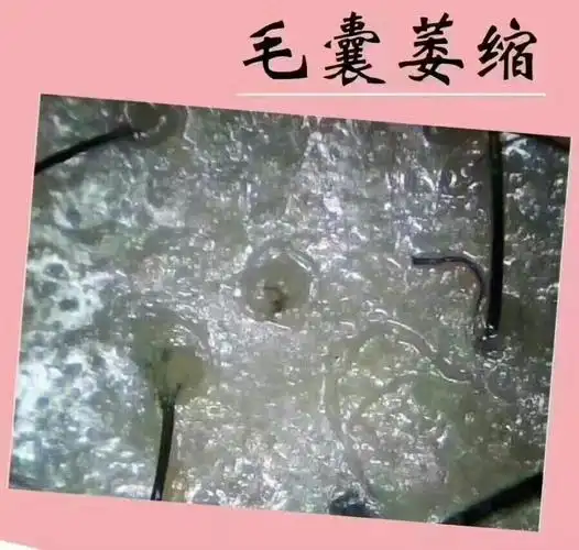毛囊萎缩:头皮呈淡黄色 毛囊口颜色较深 几乎没有头发或有1根细小