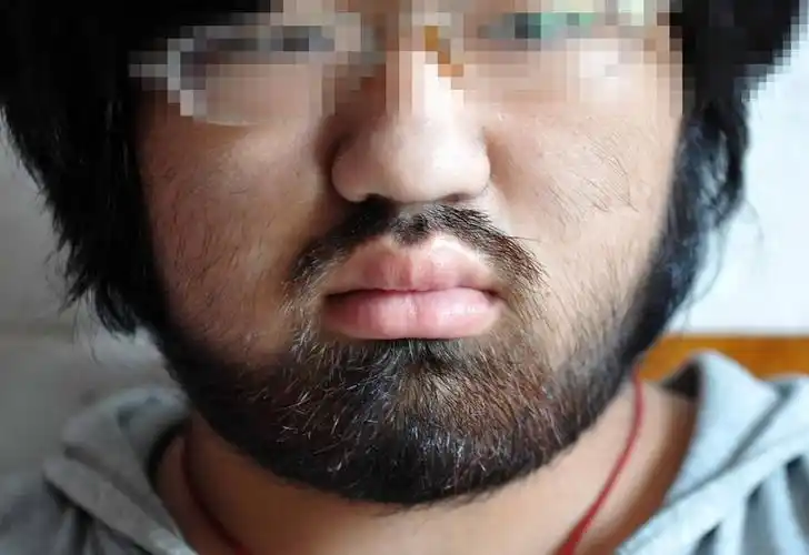 16岁少女因药物副作用满脸络腮胡