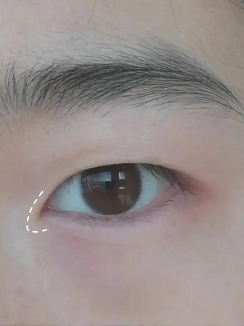 内双肿眼泡 新手内眦赘皮如何开眼角教程.#内双肿眼泡 #内眦 - 抖音