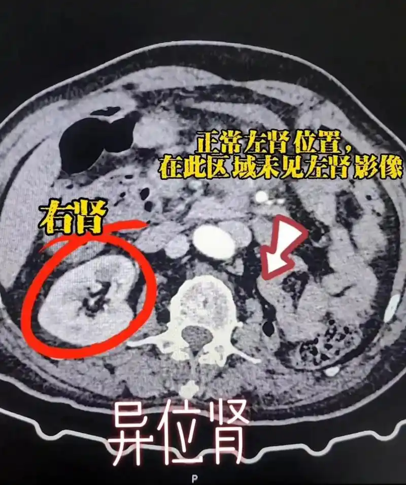 典型异位肾患者ct一例!