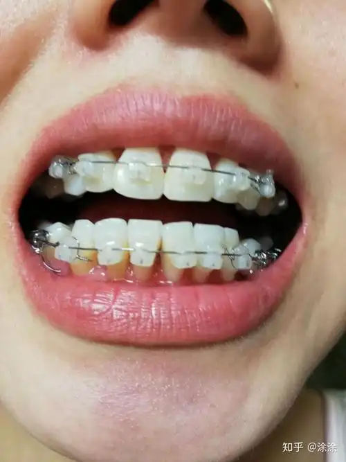 22岁东莞牙齿矫正日记陶瓷自锁牙套