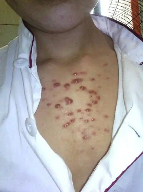 我胸部起的这是什么一2年了吃了药也不减轻