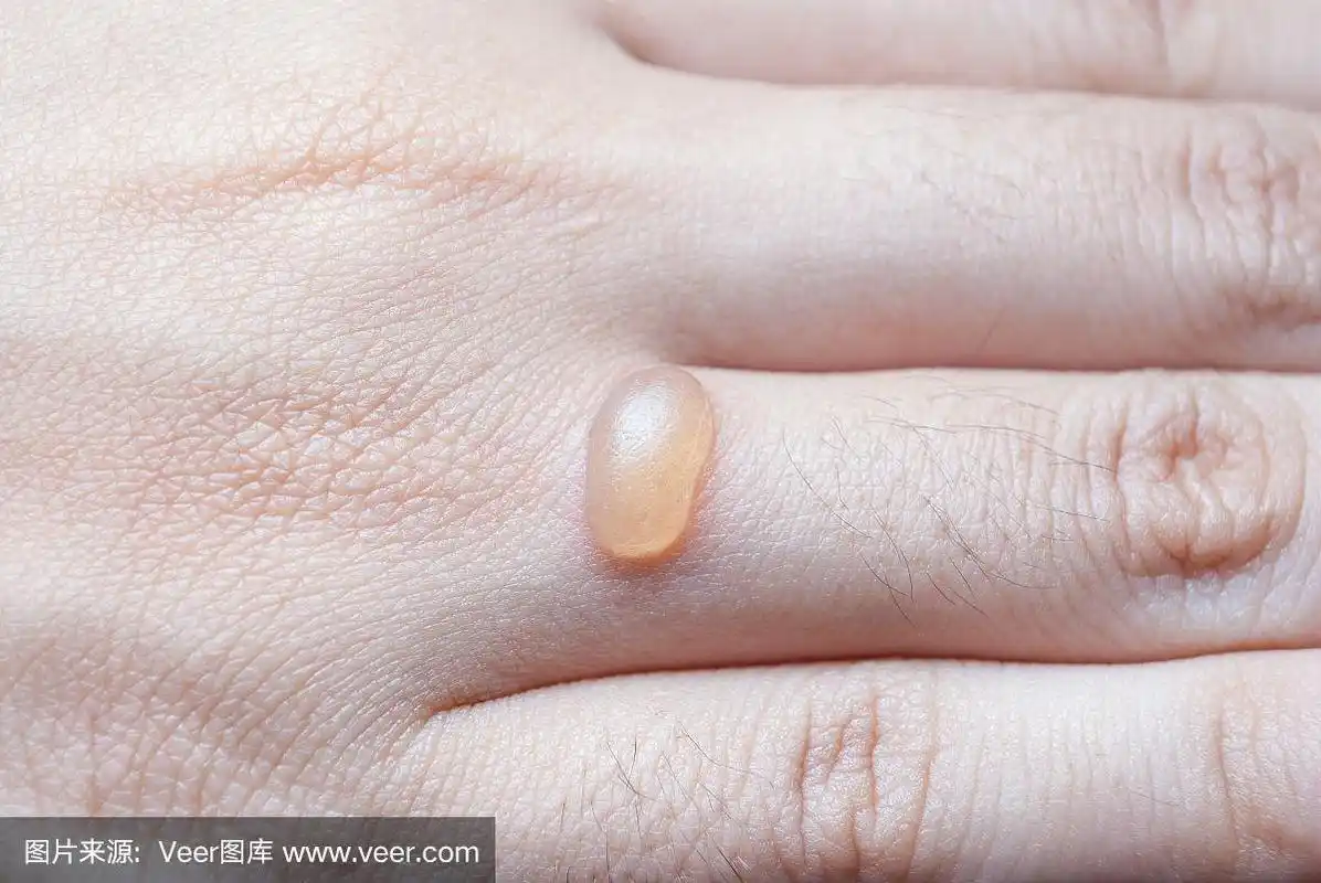 人手指上的水泡