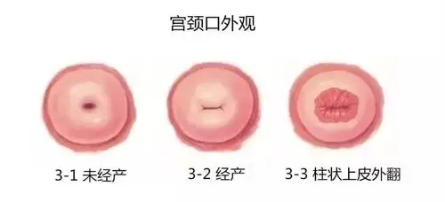 高阳妇幼61科普宫颈糜烂一个过时的诊断
