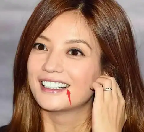 小燕子时期的赵薇,有着一口中度的四环素牙.赵薇