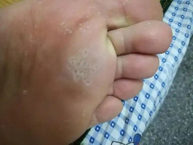 关于脚底有坑,求解