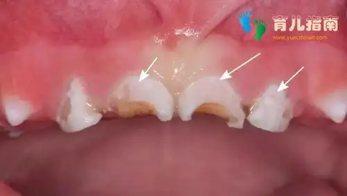 否则会影响宝宝颜值,家长跟着这样做所以说,孩子牙齿脱矿和缺钙无关