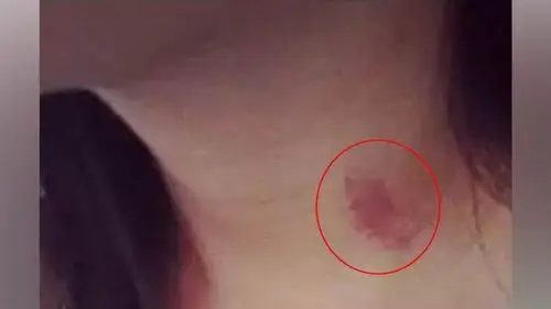 女友在脖子种草莓17岁少年中风身亡