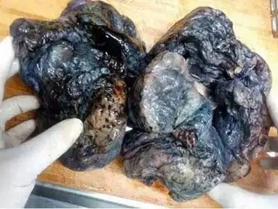 吸烟与不吸烟肺部恐怖差别触目惊心图