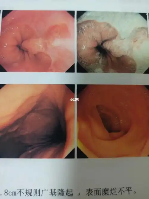 病理结果是炎性息肉伴糜烂悲伤了