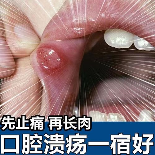 口腔溃疡专用贴一点灵凝胶嘴巴上火起泡烂舌头特效药西瓜霜喷雾剂