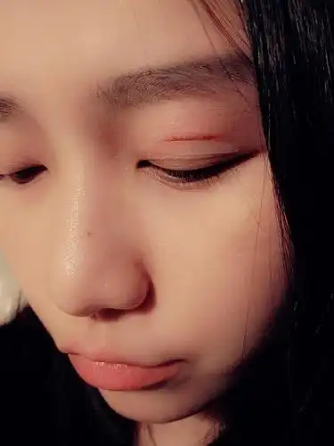 【已更新】我用双眼皮贴把眼皮贴发炎了求破qvq有图.