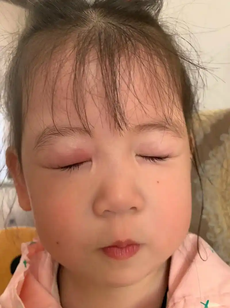 突然冒出来的库存之果果被蚊子咬到眼睛.