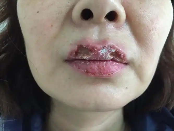 唇炎治疗集锦 - 好大夫在线