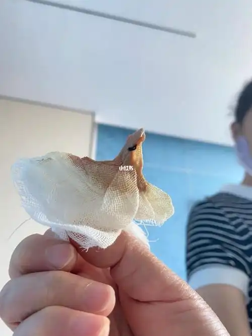 痔疮手术第十五天