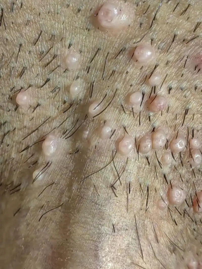 阴部传染性软疣症状 #传染性软疣