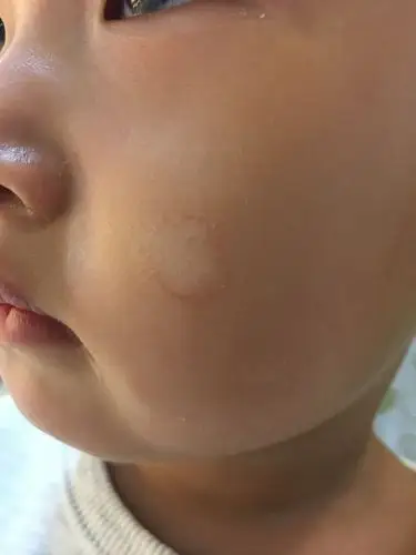 2岁半宝宝脸上突然有个白斑