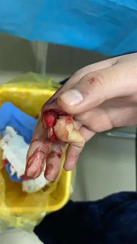 吓人,洗衣机绞断少年手指!