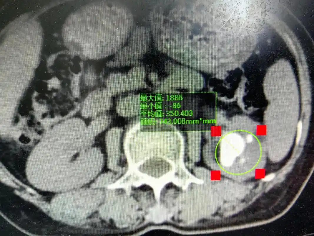 肾结石的硬度已经颠覆了医生的认知,肾结石的ct值了解一下