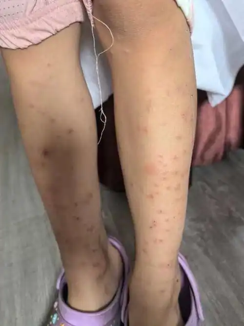 干性湿疹在治疗过程中可能会发出来很多小水泡,是好现象.