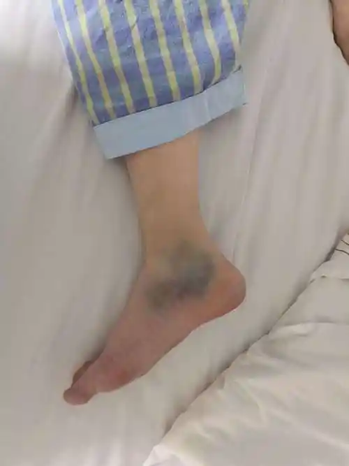 踝关节的微创治疗_踝部扭伤_手术_治疗方法_治疗方式 - 好大夫在线