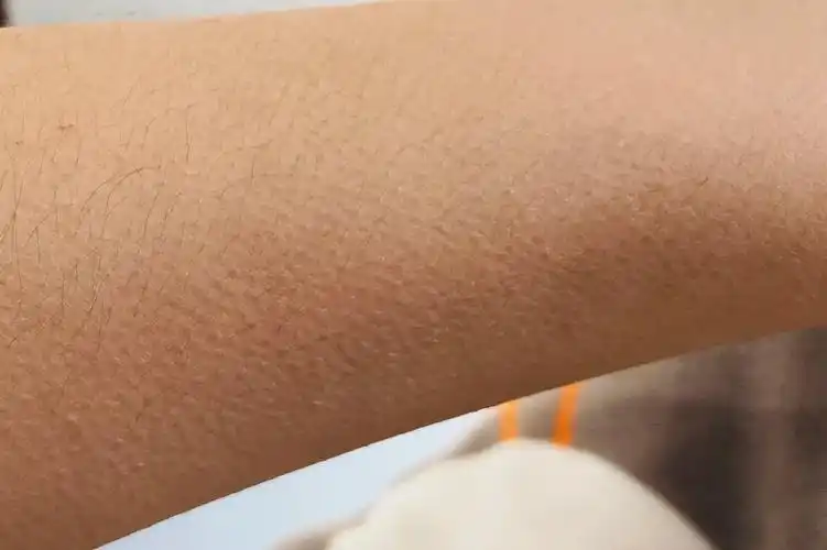 1,毛周角化以毛囊口密集的微小角栓,形成针尖大小的角化性丘疹为主要