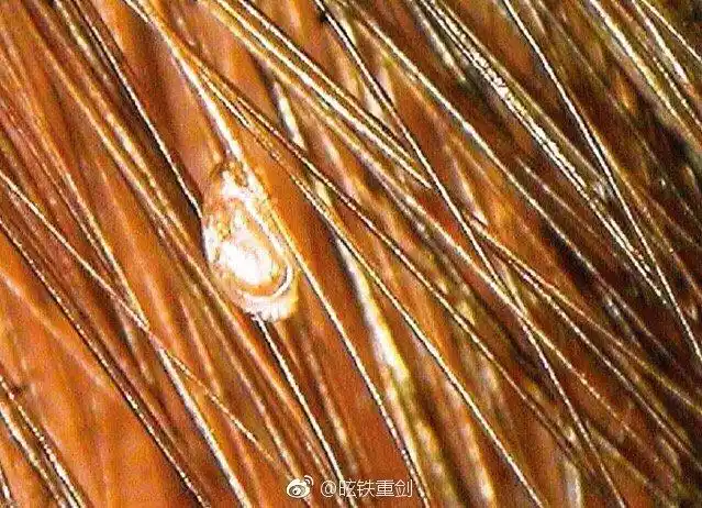 头虱通常只寄生在头发上,特别是耳后区域的头发,它们会在发根产卵