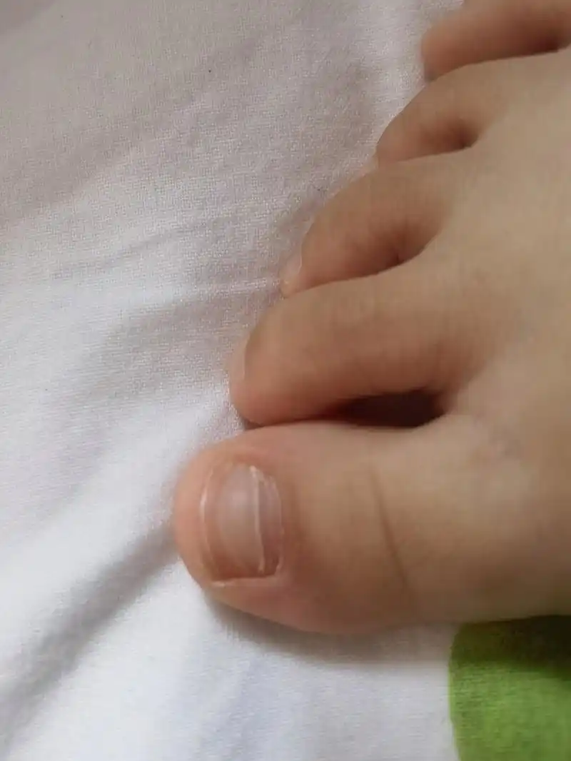 宝宝脚趾甲有横线是怎么回事 今天帮宝宝剪指甲,发现脚趾甲上不知道