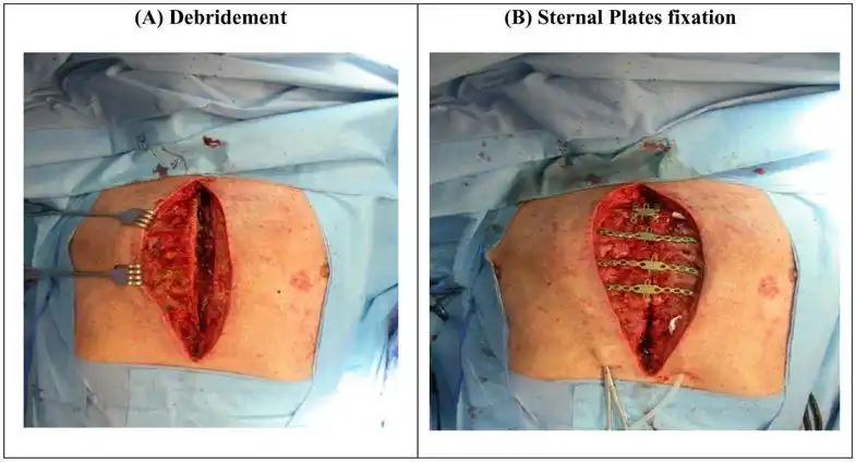 sternal plate fixation for sternal wound reconstruction: initial