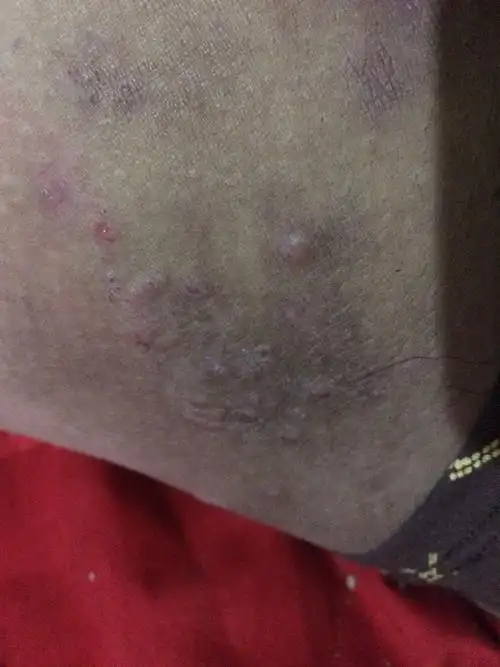 (找皮肤大夫)大腿内侧瘙痒,皮肤发黑,这是什么病?