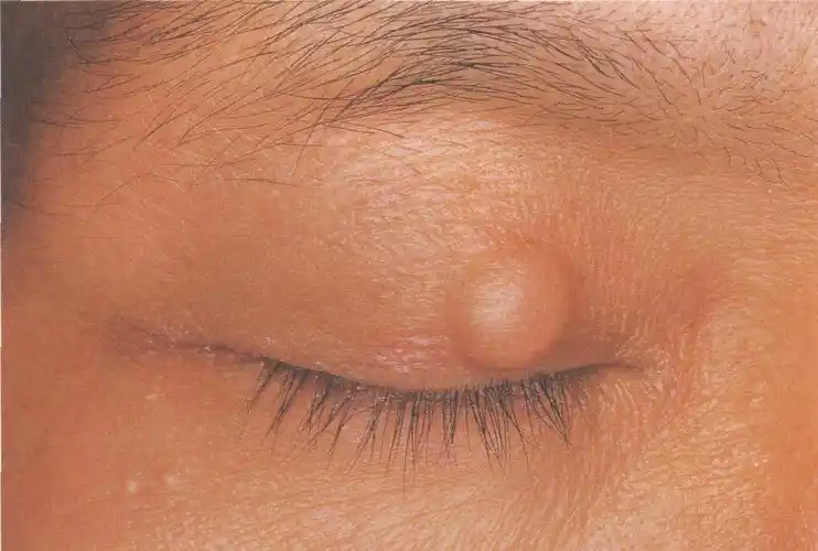 (图) 上睑霰粒肿