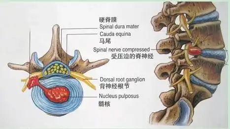 腰椎间盘突出压迫神经,腿疼,腿麻该如何解决