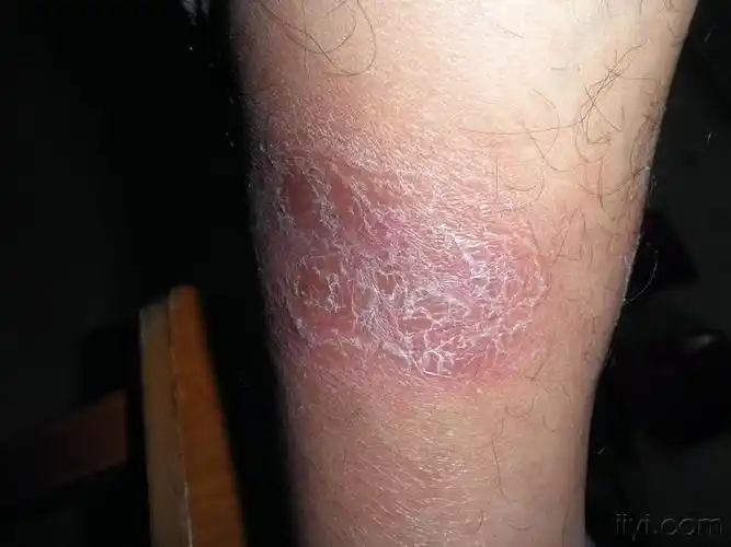 系列皮肤病-硬化性脂膜炎