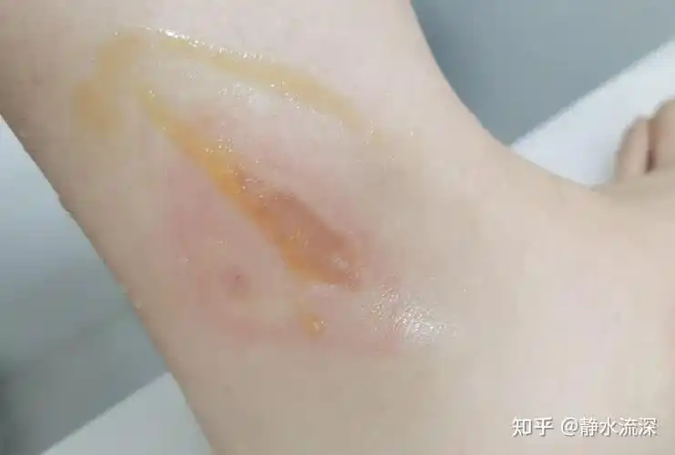 热水袋低温烫伤记录图片