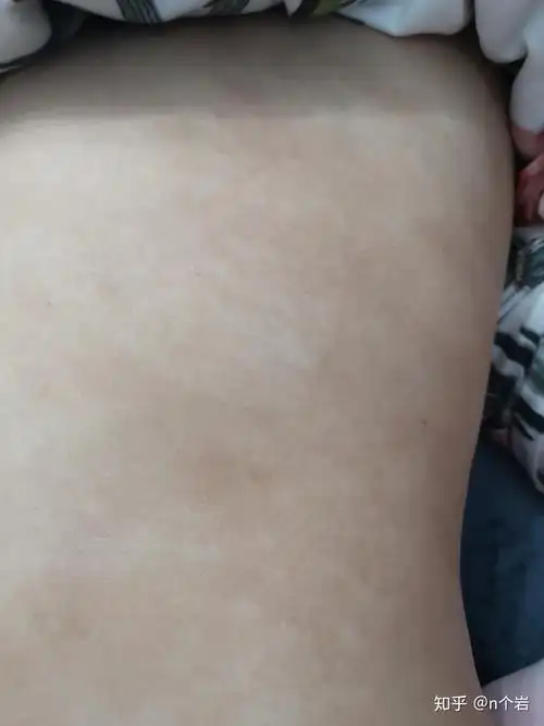 肚子上这个是汗斑么