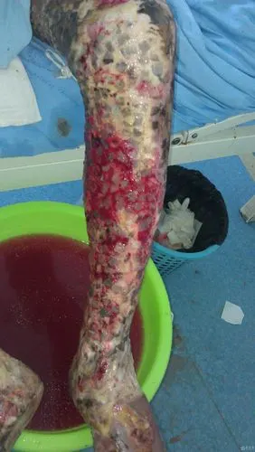 求双下肢大面积34度烧伤后续治疗方案