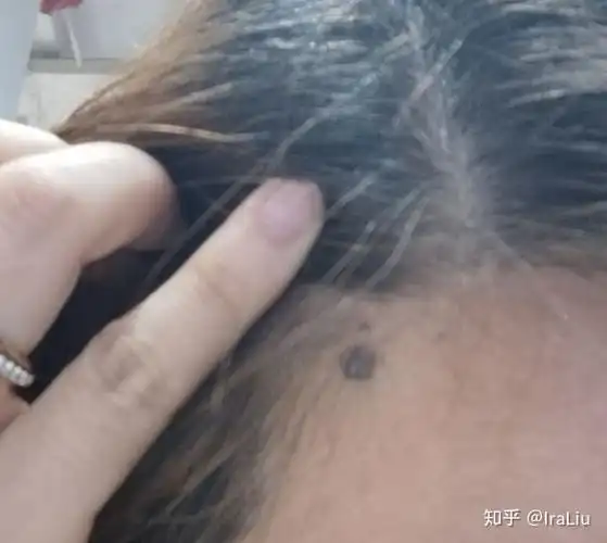 发际线大痣切除手术记录