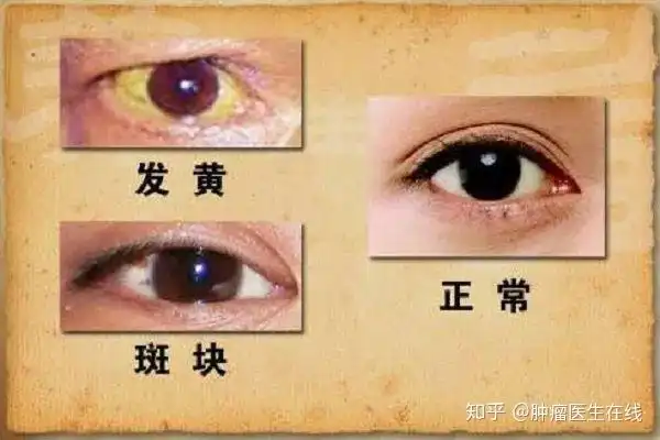 肝不好眼知道眼睛若有这种症状请重视