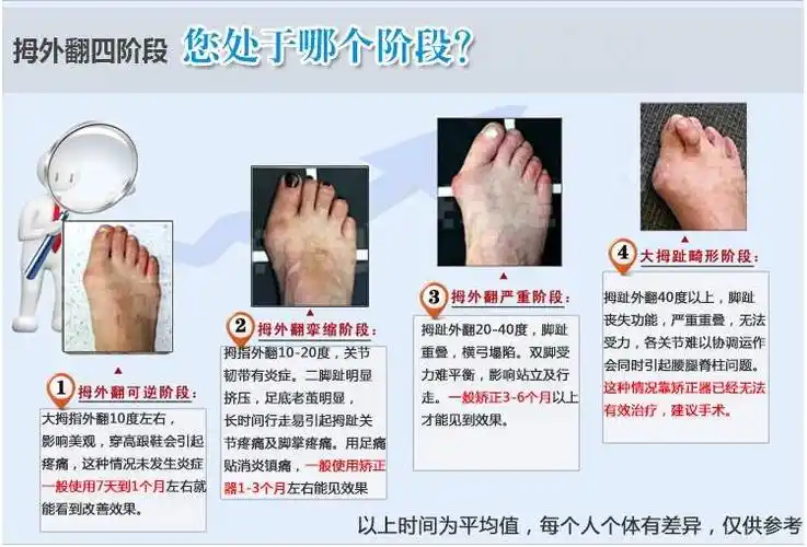 拇指外翻,告别夏天